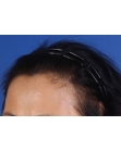 After Hair Transplant&nbsp;Hair Thinning